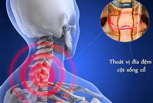 Bệnh thoát vị đĩa đệm cột sống cổ
