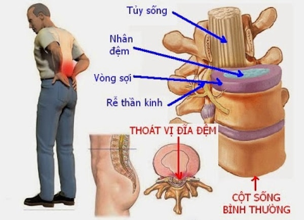 Bệnh thoát vị đĩa đệm