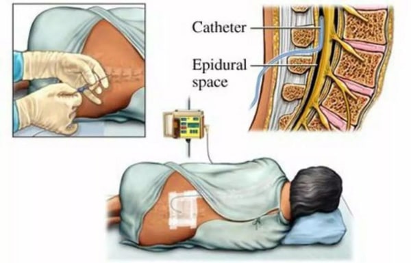 Tiêm ngoài màng cứng điều trị thoát vị đĩa đệm