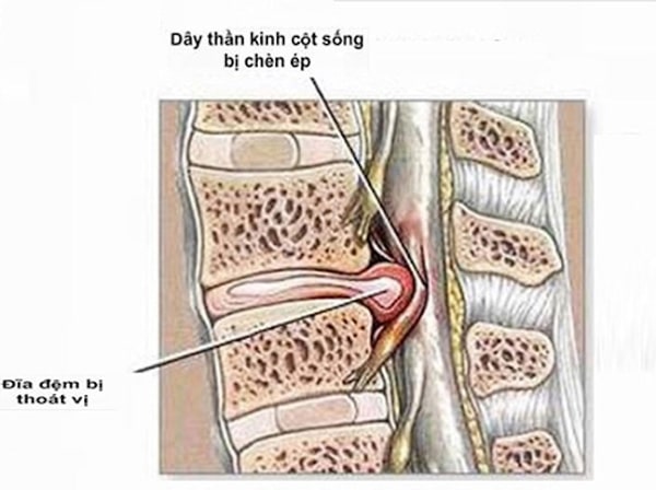 Trường hợp chỉ đinh tiêm ngoài màng cứng