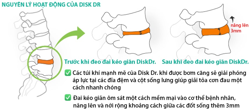 Nguyên lý hoạt động của đai kéo giãn cột sống DiskDr.
