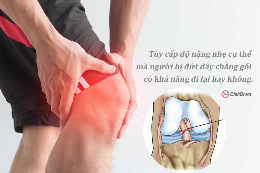 Đứt dây chằng có thể đi lại không