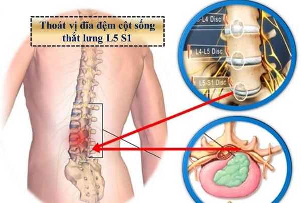 Thoát vị đĩa đệm cột sống thắt lưng