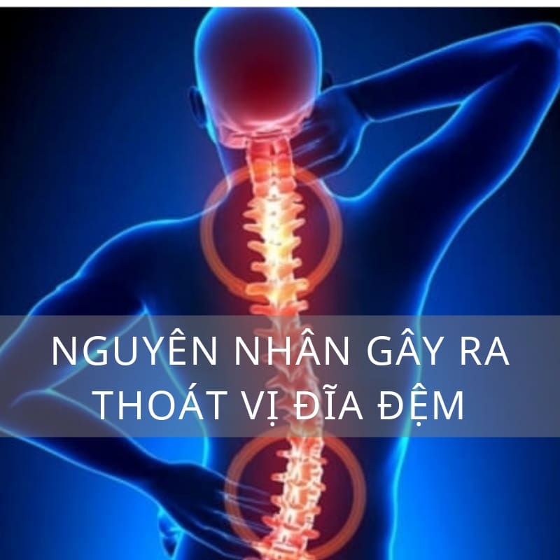 nguyên nhân gây ra thoát vị đĩa đệm