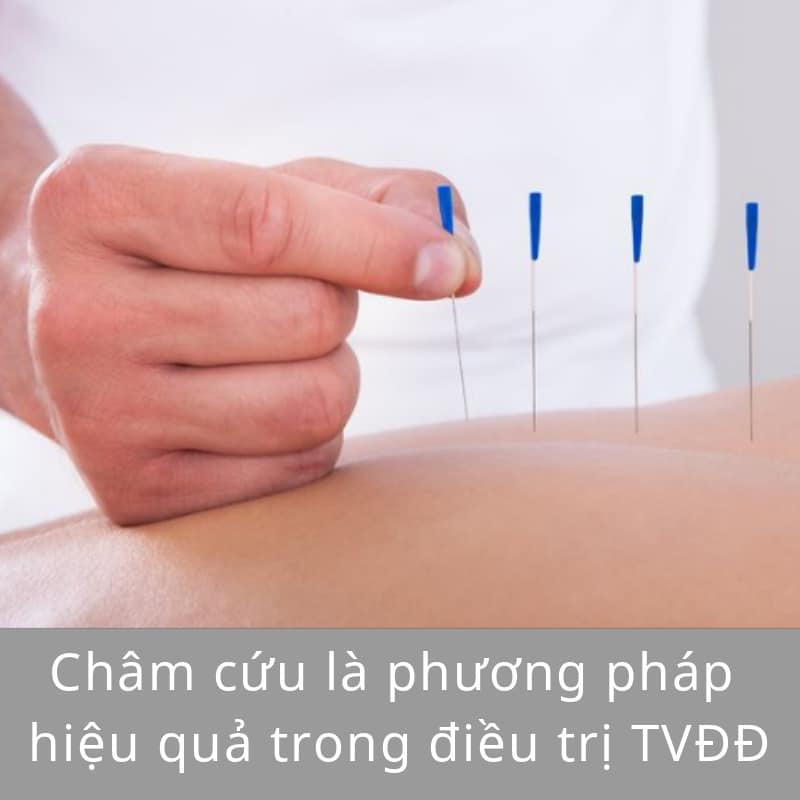 châm cứu là phương pháp hiệu quả