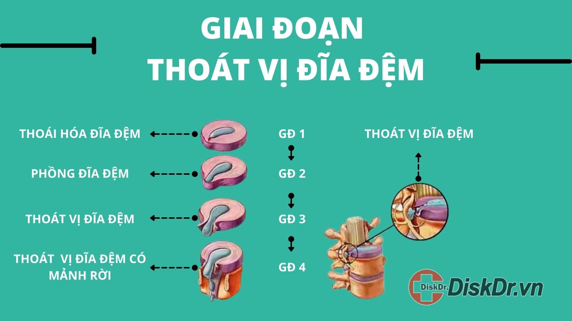 Giai đoạn thoát vị đĩa đệm