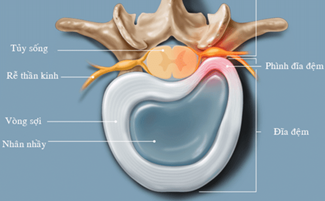Phình đĩa đệm là bệnh lý rất hay xảy ra hiện nay