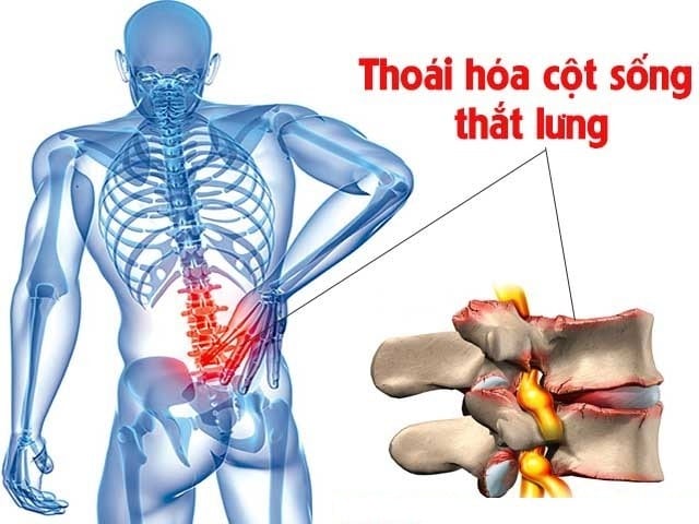 Thoái hóa cột sống lưng là nỗi ám ảnh với nhiều người