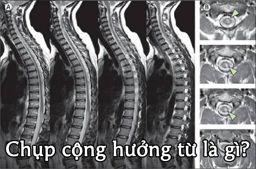 Chụp cộng hưởng từ là gì?