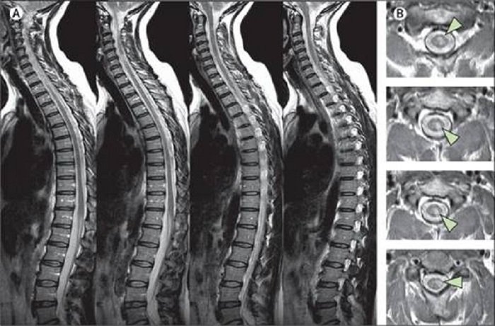 Hình ảnh cột sống sau khi chụp cộng hưởng từ