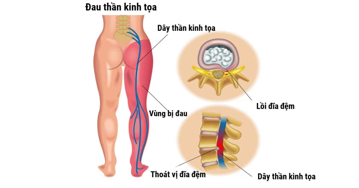 Đau thần kinh tọa có thể do thoát vị đĩa đệm gây ra