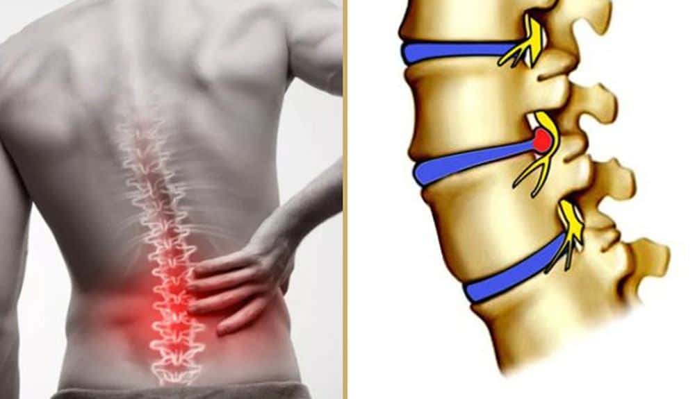 Thoát vị đĩa đệm là gì?