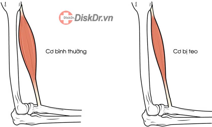 Thoát vị đĩa đệm cũng có thể gây ra teo cơ