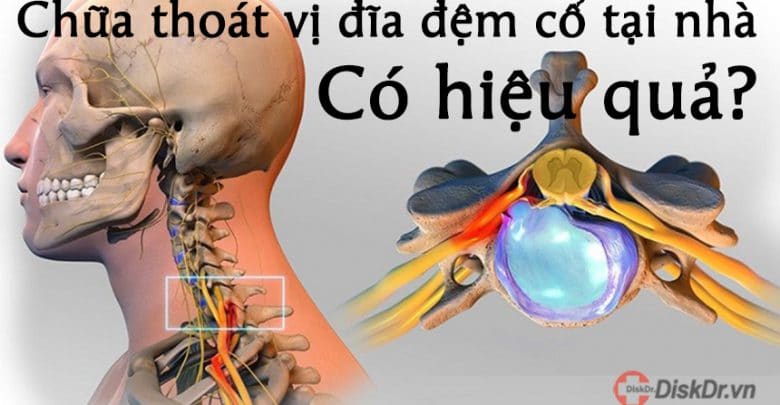 Chữa thoát vị đĩa đệm tại nhà có hiệu quả?