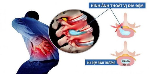 Đai lưng DiskDr điều trị hiệu quả thoát vị đĩa đệm