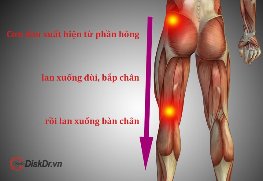 Cơn đau chạy dọc theo đường đi của dây thần kinh tọa