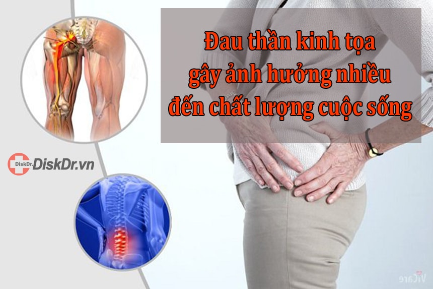 Đau thần kinh tọa ảnh hưởng nhiều tới chất lượng cuộc sống