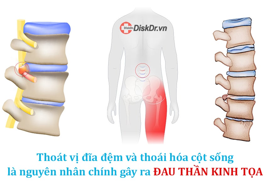 Thoát vị đĩa đệm và thoái hóa cột sống là nguyên nhân chính gây đau thần kinh tọa