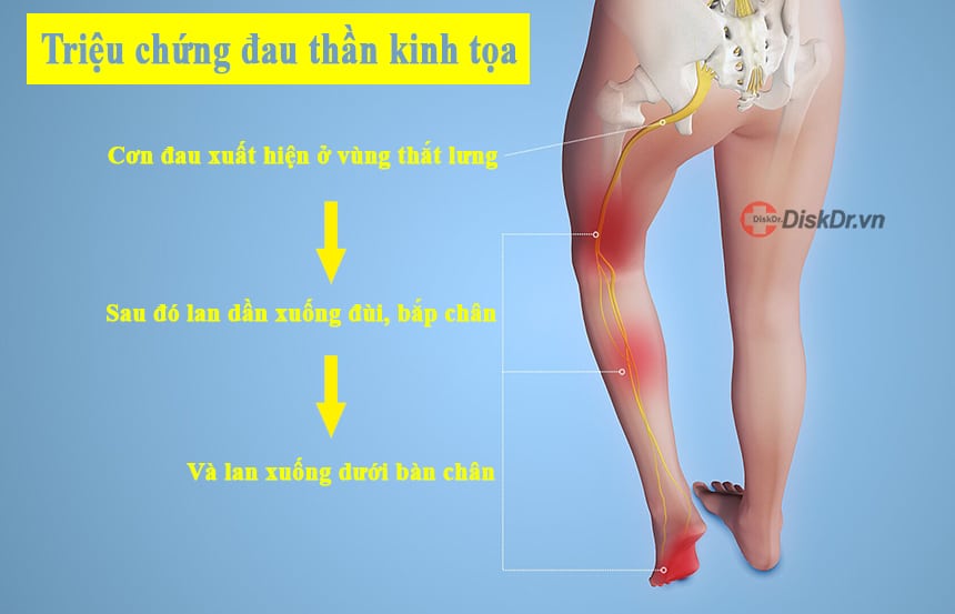 Triệu chứng đau thần kinh tọa