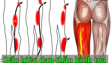 Những dấu hiệu đau thần kinh tọa