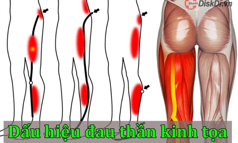 Những dấu hiệu đau thần kinh tọa