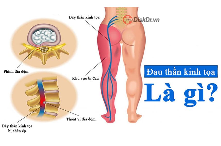 Đau thần kinh tọa là gì?