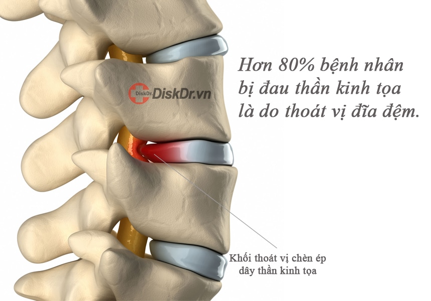 Thoát vị đĩa đệm là nguyên nhân chính gây đau thần kinh tọa