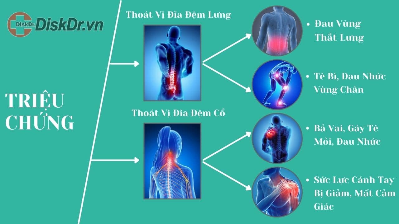 Triệu chứng thoát vị đĩa đệm lưng, cổ