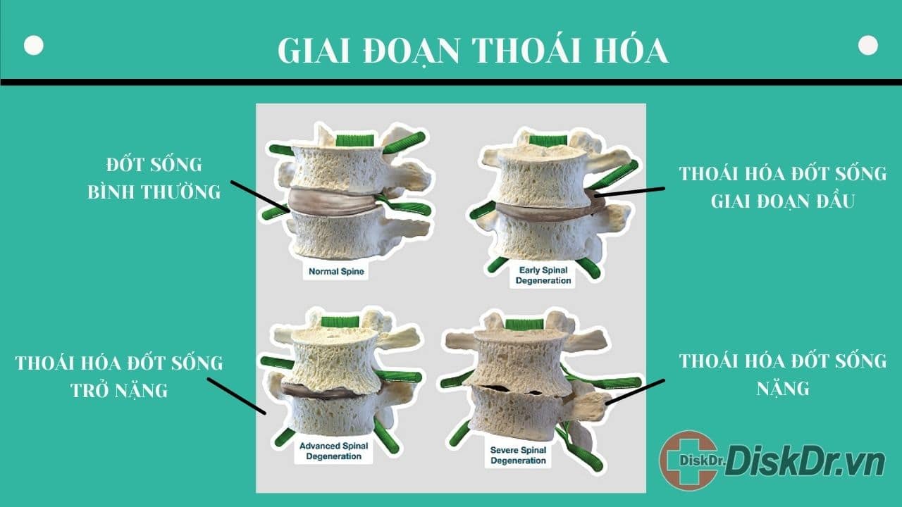 Giai đoạn thoái hóa cột sống