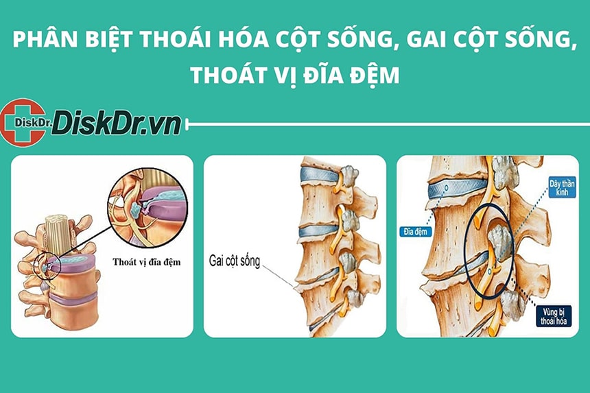 Phân biệt thoát hóa cột sống, gai cột sống và thoát vị đĩa đệm