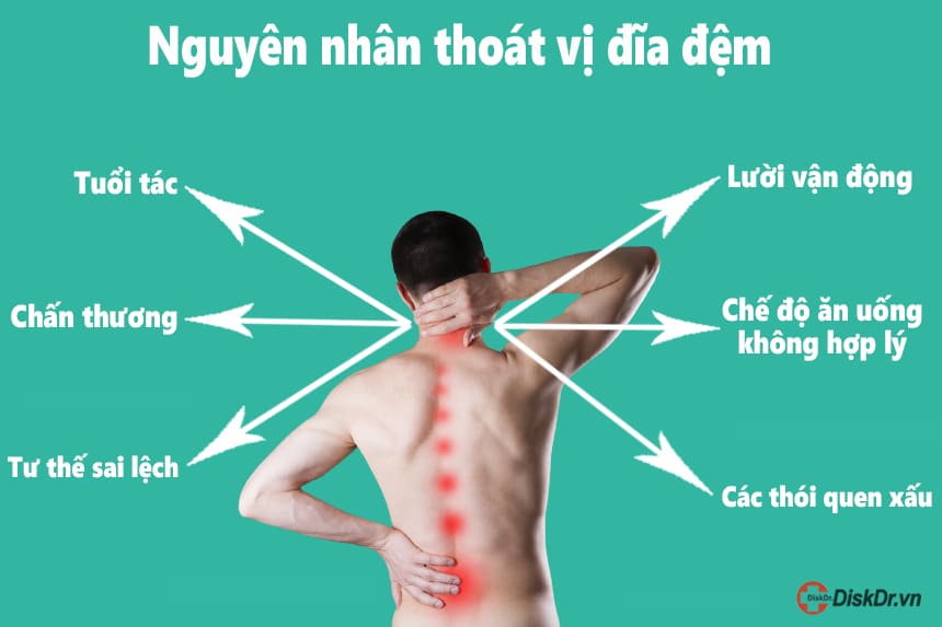 Nguyên nhân thoát vị đĩa đệm