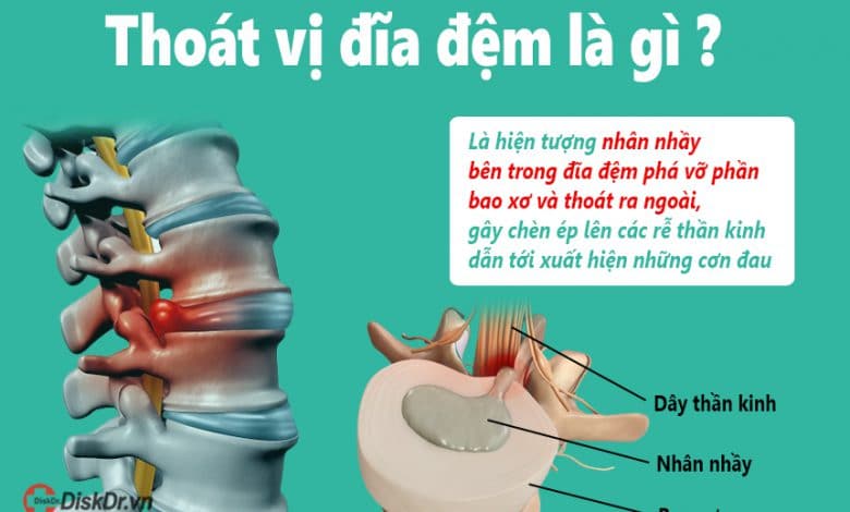 Thoát vị đĩa đệm là gì