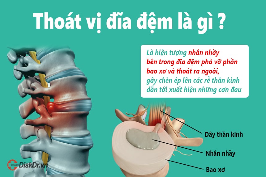 Thoát vị đĩa đệm là gì