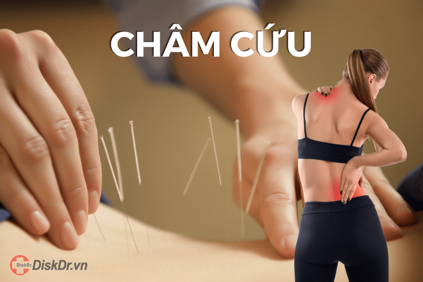 Châm cứu