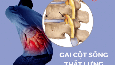 Gai cột sống thắt lưng