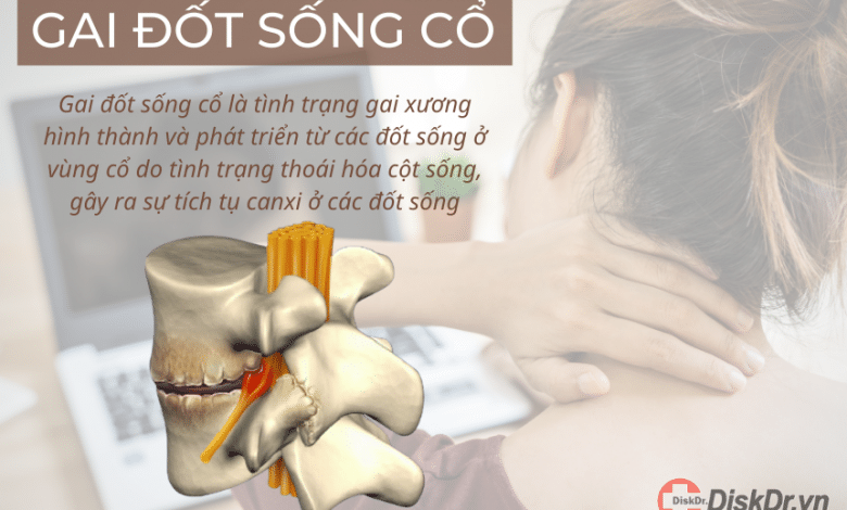 Gai đốt sống cổ là gì