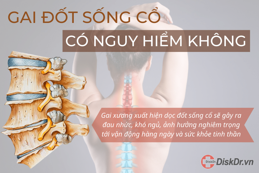 Gai đốt sống cổ có nguy hiểm không