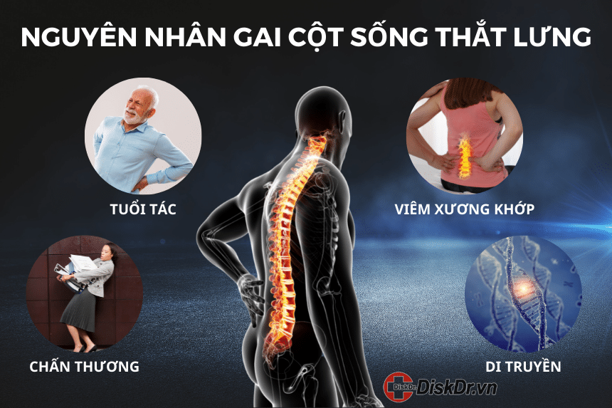 Nguyên nhân gai cột sống thắt lưng