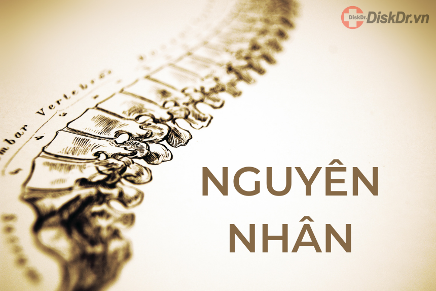 Nguyên nhân thoái hóa cột sống