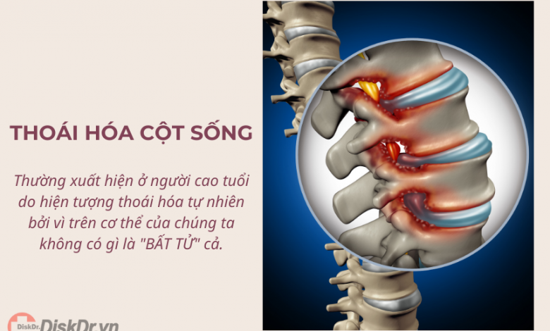 Thoái hóa cột sống