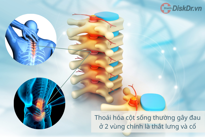 Thoái hóa cột sống thường xảy ra ở vùng thắt lưng và cổ