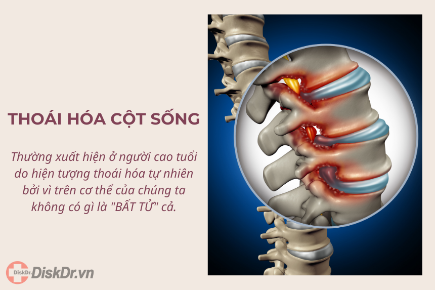 Thoái hóa cột sống