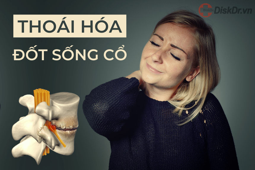 Thoái hóa đốt sống cổ