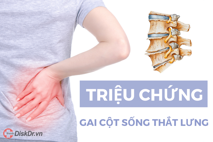 Triệu chứng gai cột sống thắt lưng