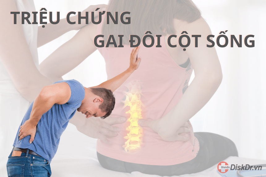 Triệu chứng gai đôi cột sống