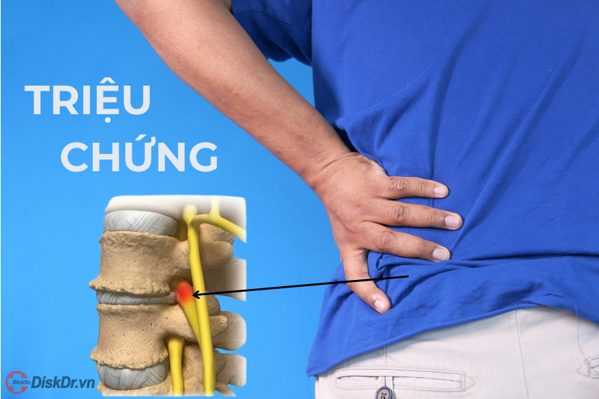 Triệu chứng thoái hóa cột sống thắt lưng