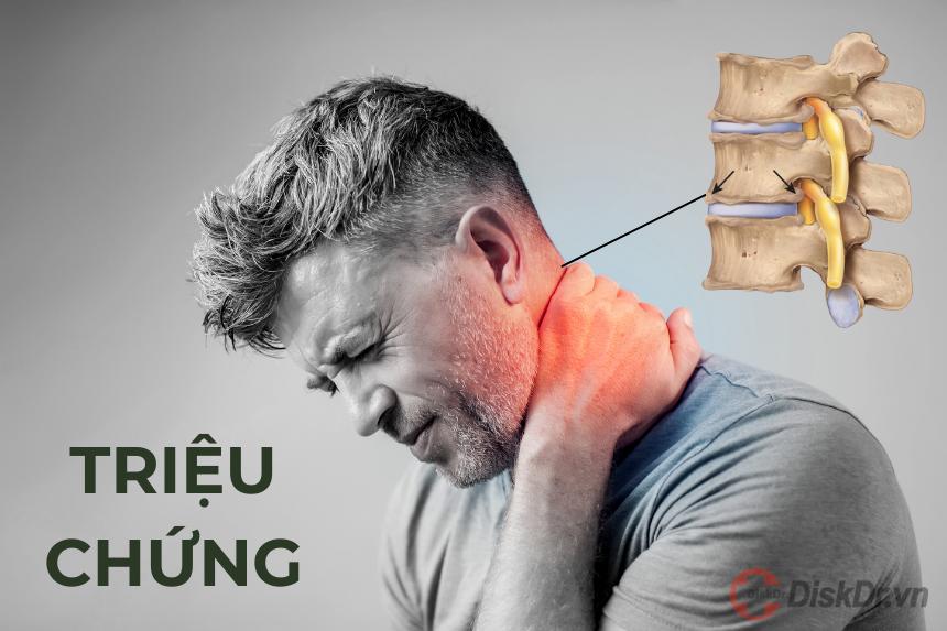 Triệu chứng thoái hóa đốt sống cổ