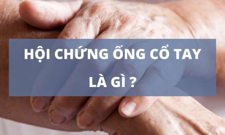 Hội chứng ống cổ tay là gì?