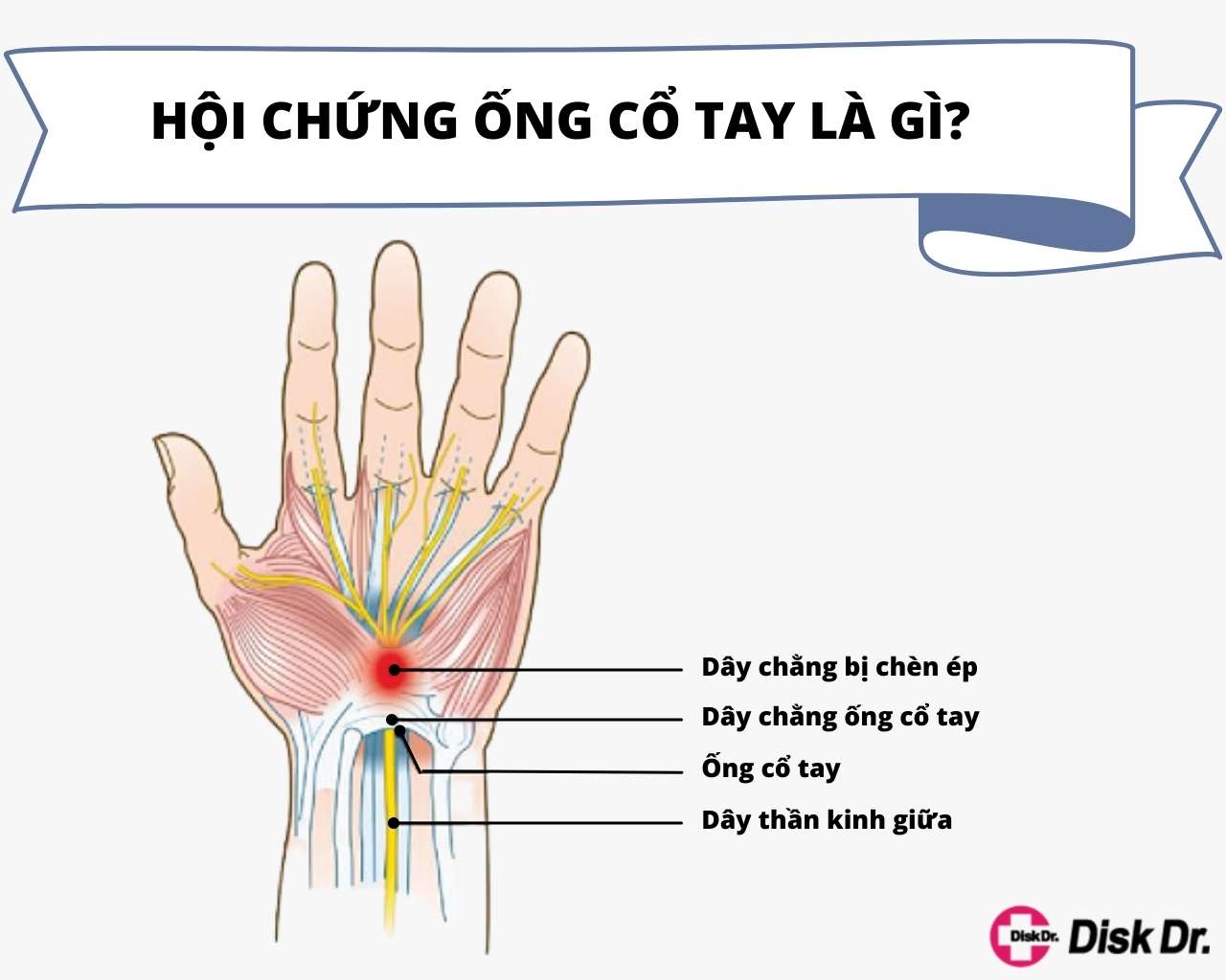 Hội chứng ống cổ tay khi mang thai