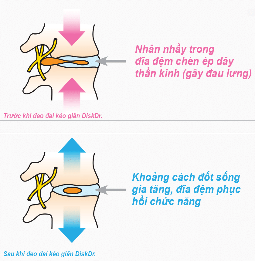 Sử dụng đai lưng diskdr như thế nào